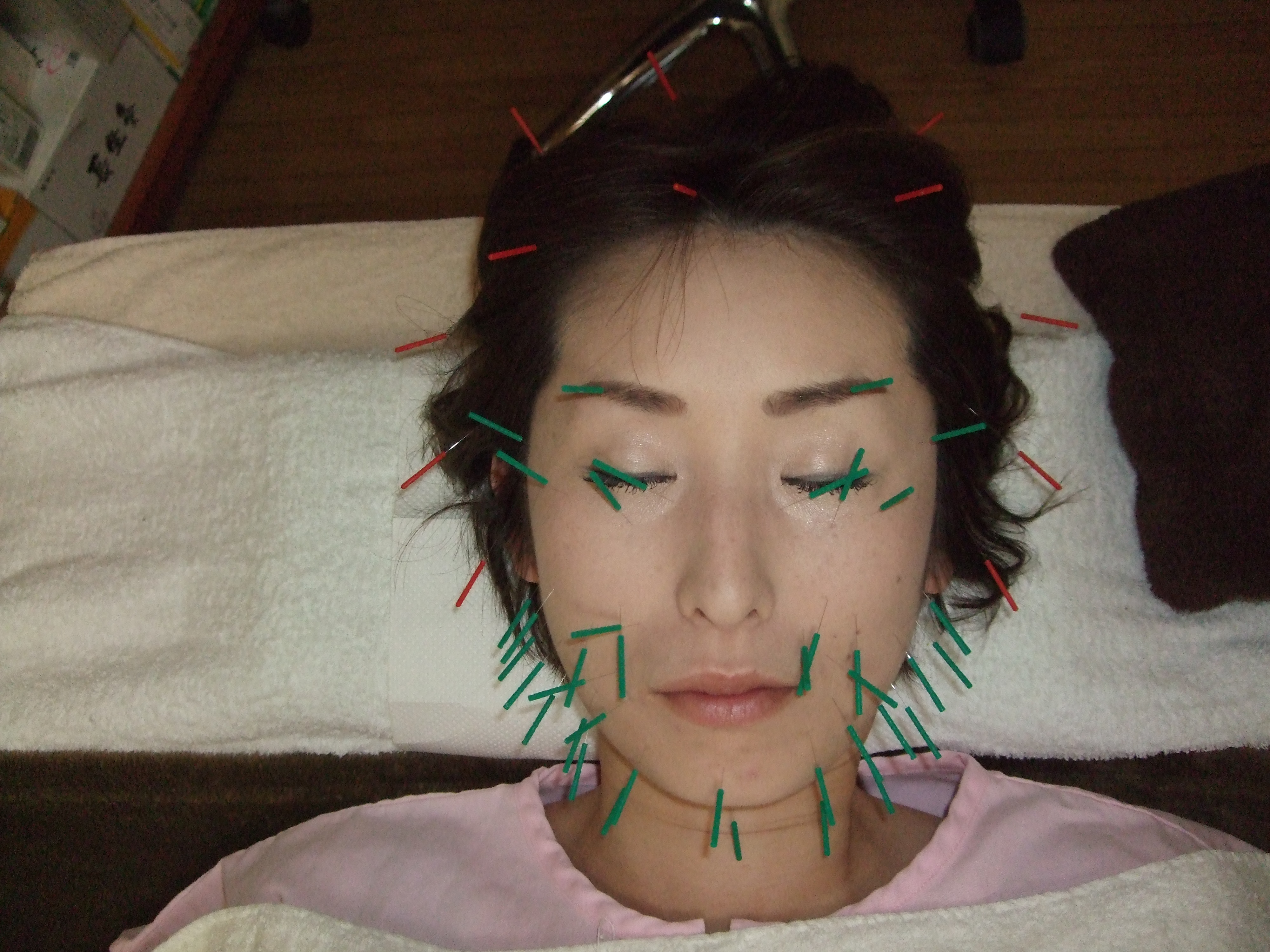 美顔鍼施術の画像