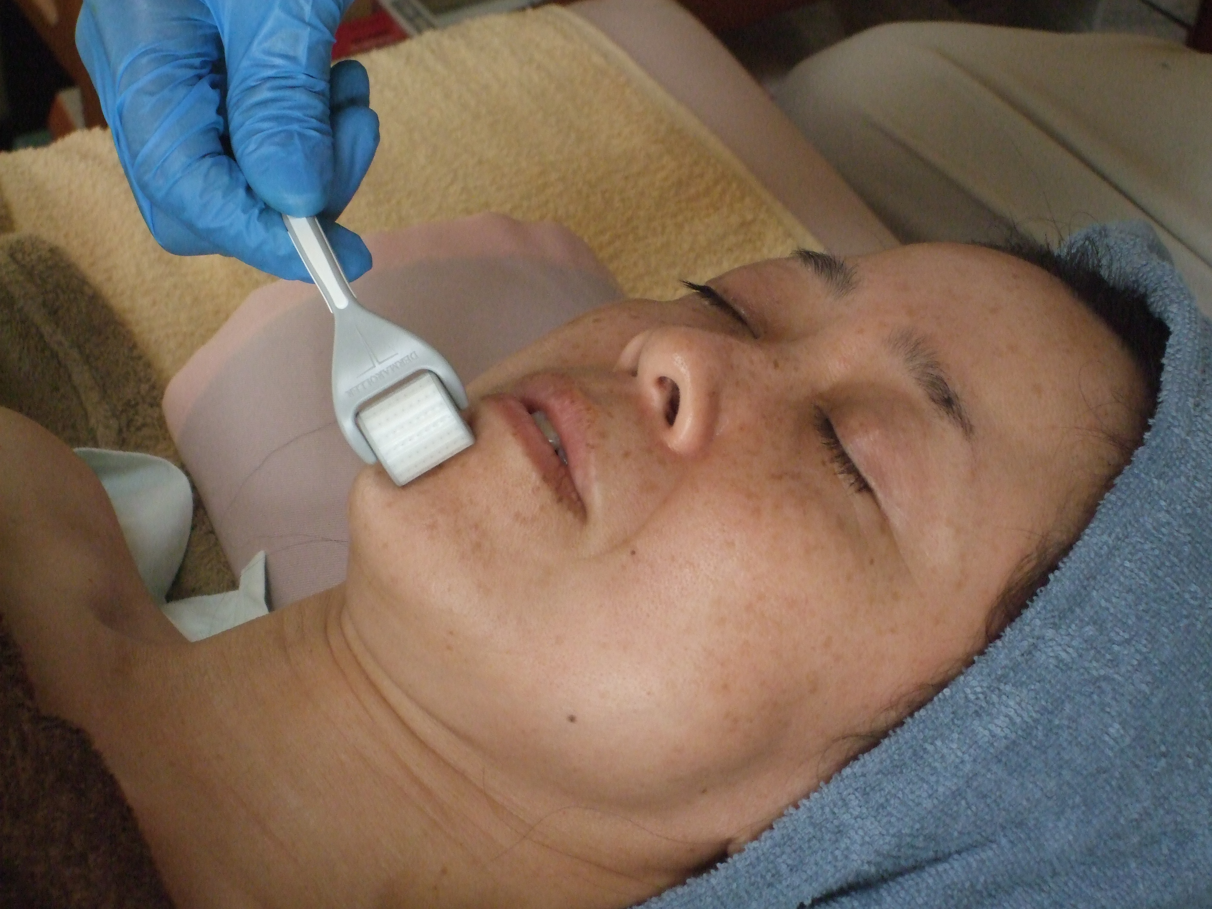 ダーマローラー美容施術の画像