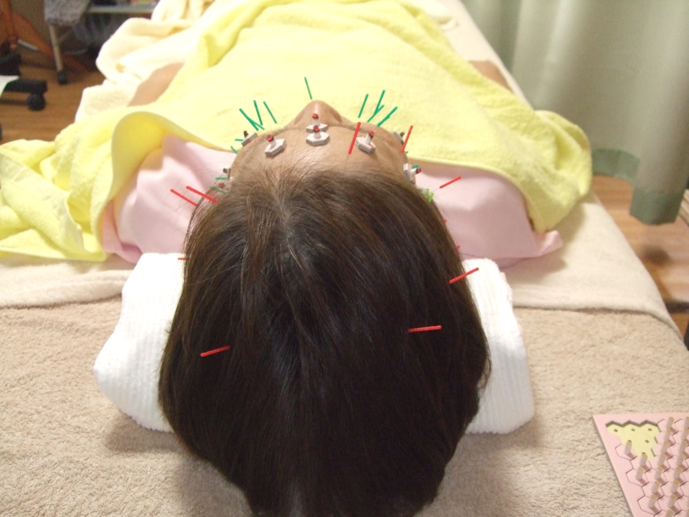 頭部・顔面への美容鍼施術の画像