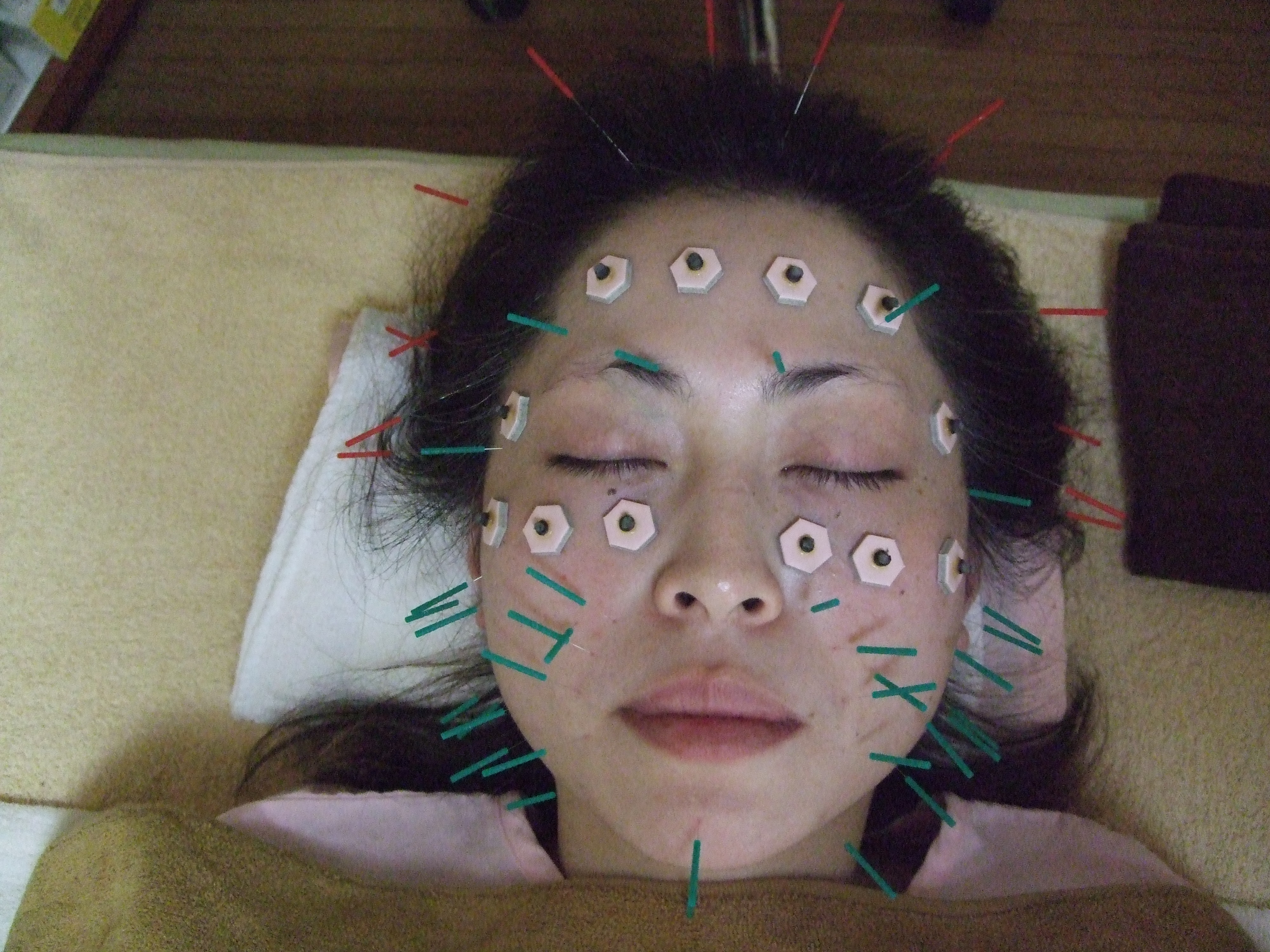 顔面・頭部への美容鍼・お灸施術の画像