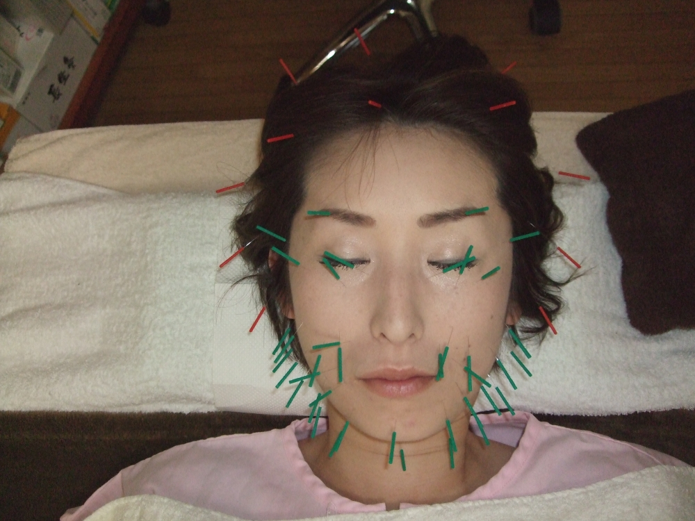 美顔鍼 顔面刺鍼施術の画像