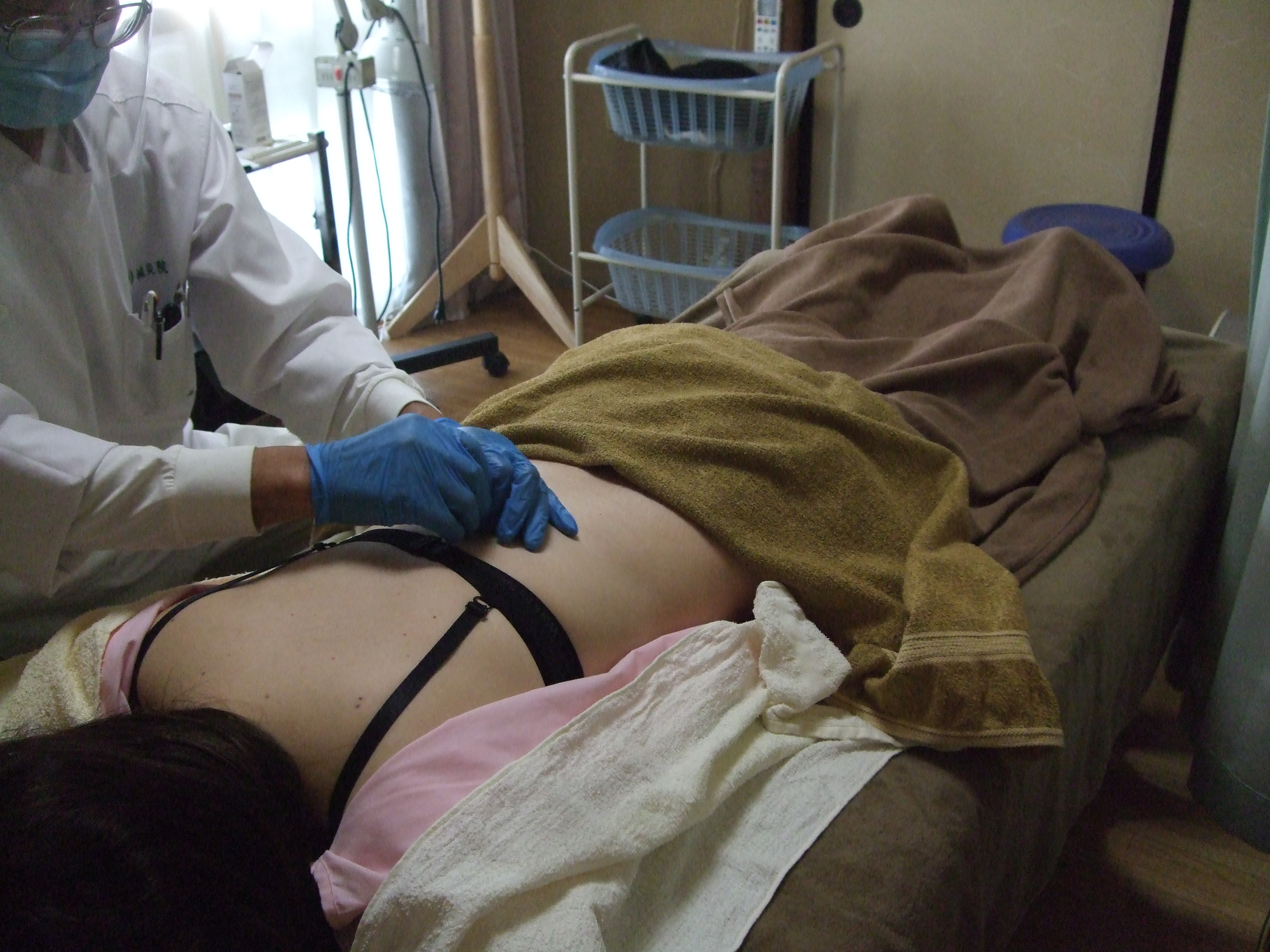 背部接触鍼施術の画像