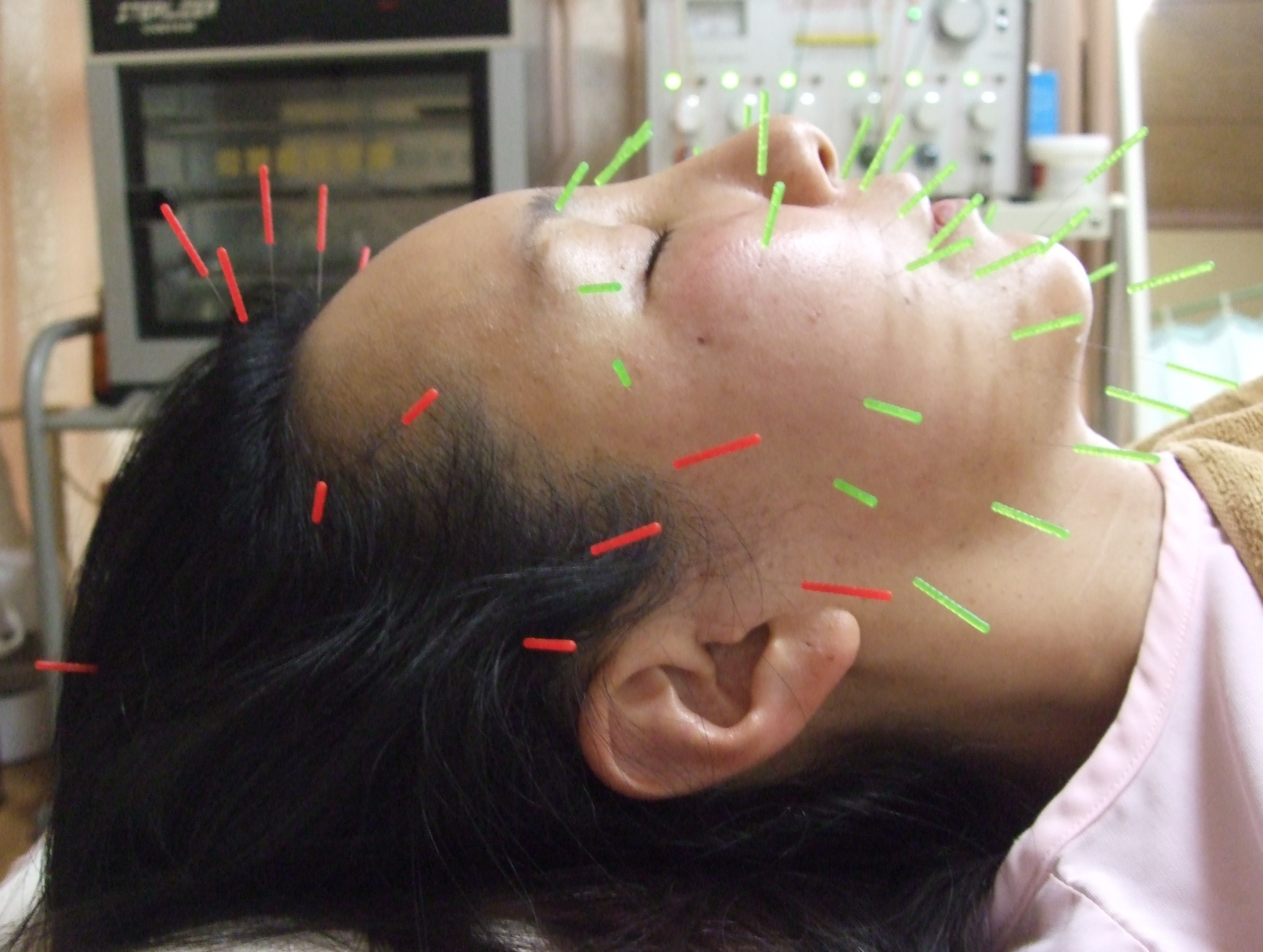 お顔への美容鍼の画像
