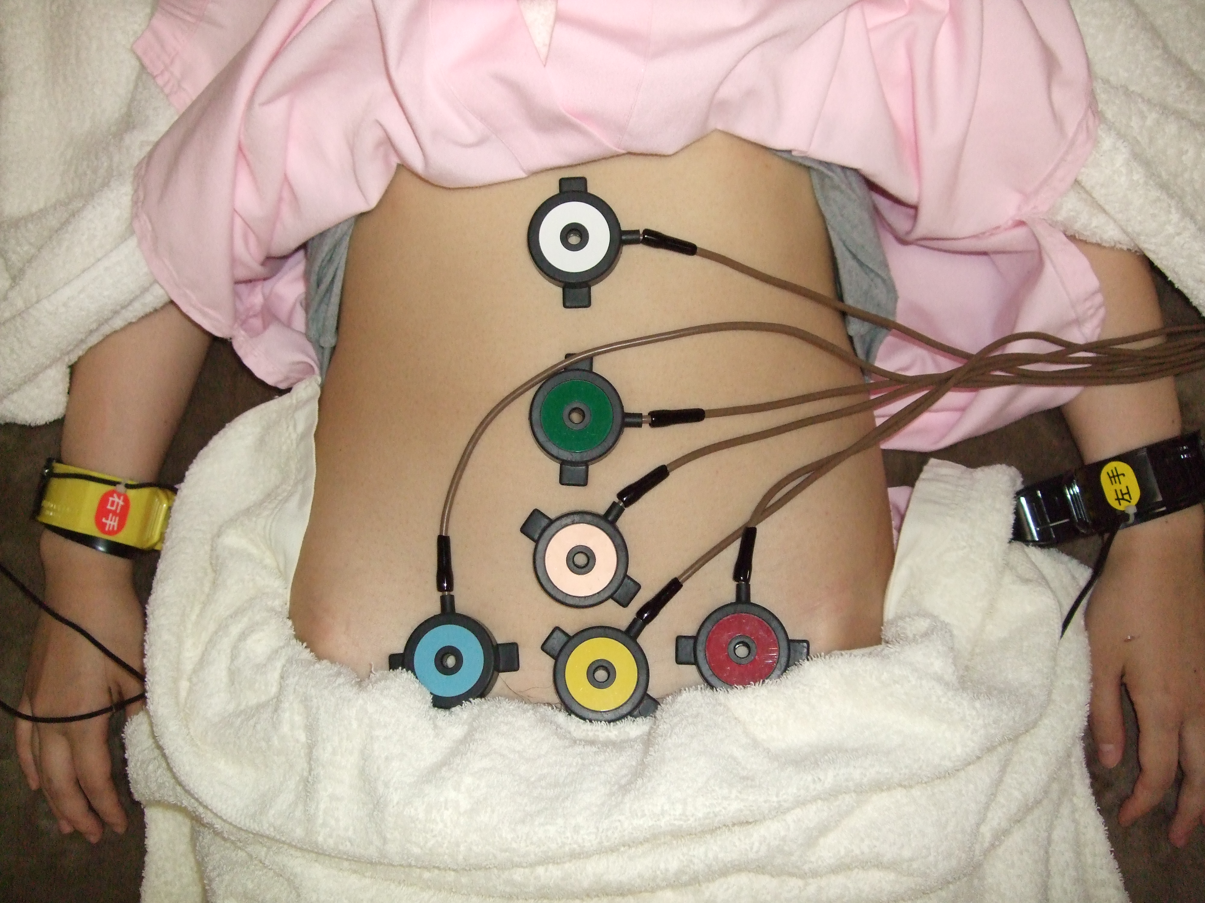 刺鍼後腹部温灸器施術・手首マイクロカレント施術の画像