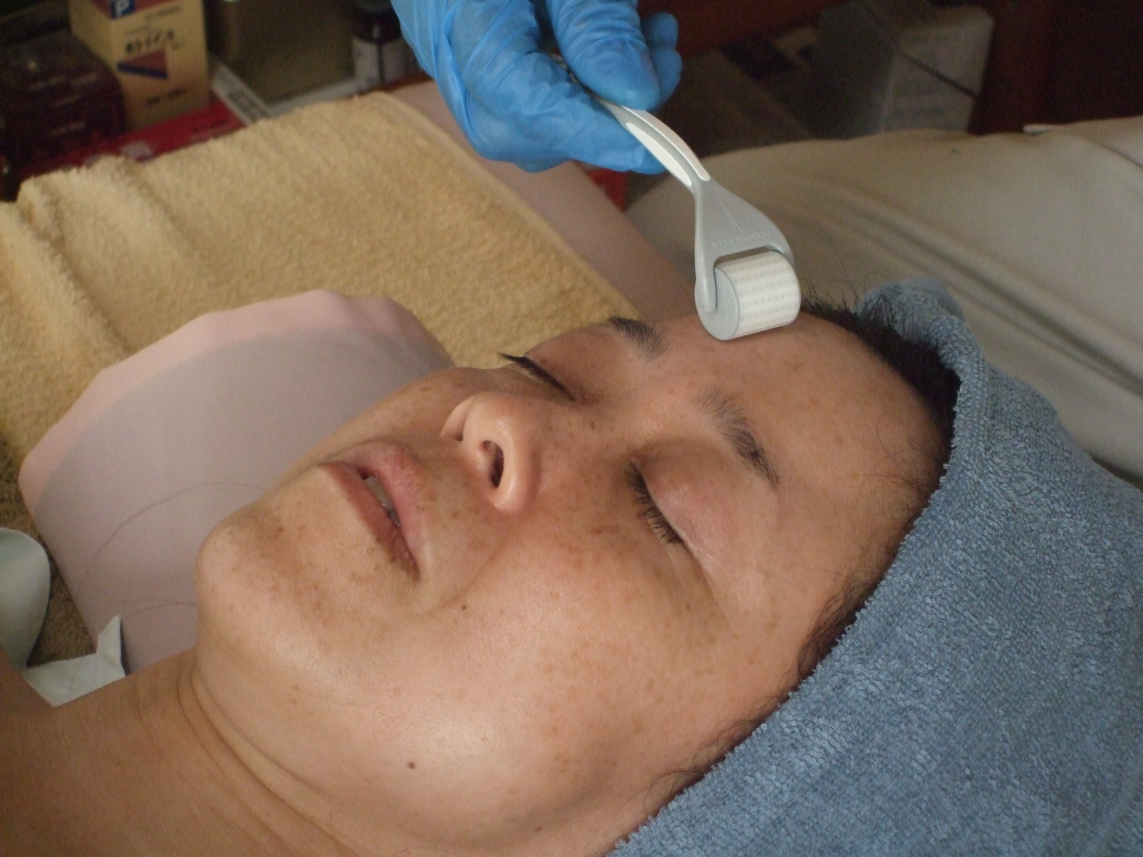 ダーマローラー施術　首から顔面を縦・横・斜めに回転しながら皮膚に微細なキズをつけます。の画像