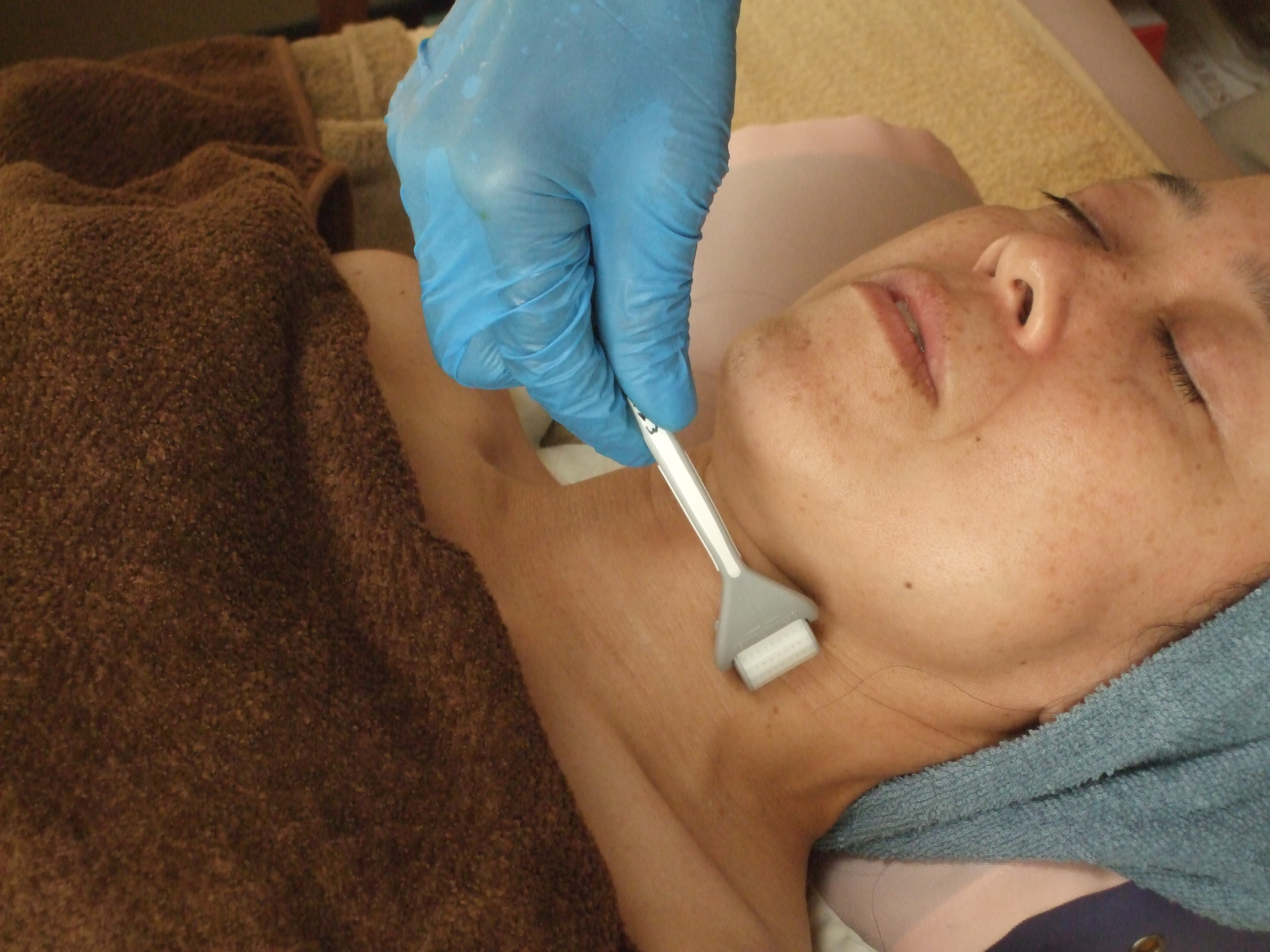 ダーマローラー施術　首から顔面を縦・横・斜めに回転しながら皮膚に微細なキズをつけます。の画像