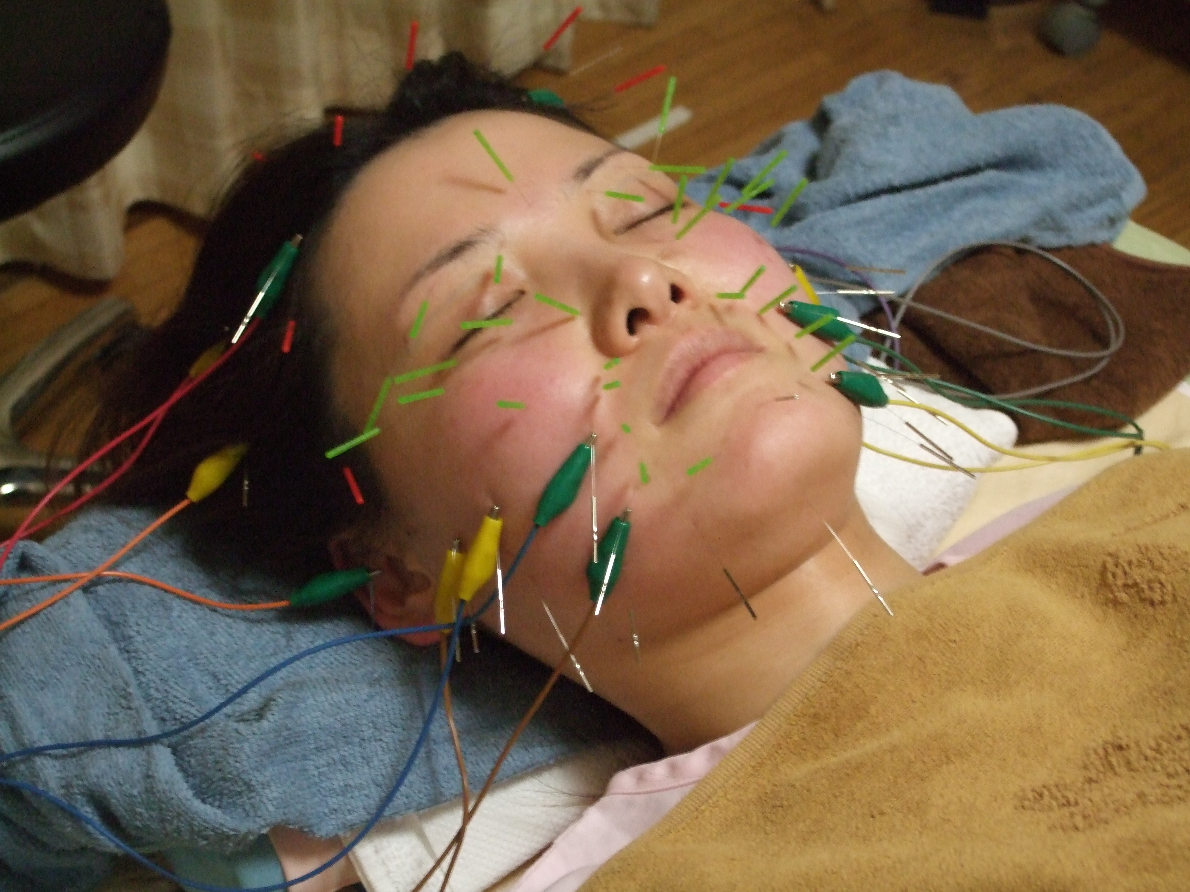 立体造顔美容鍼の画像