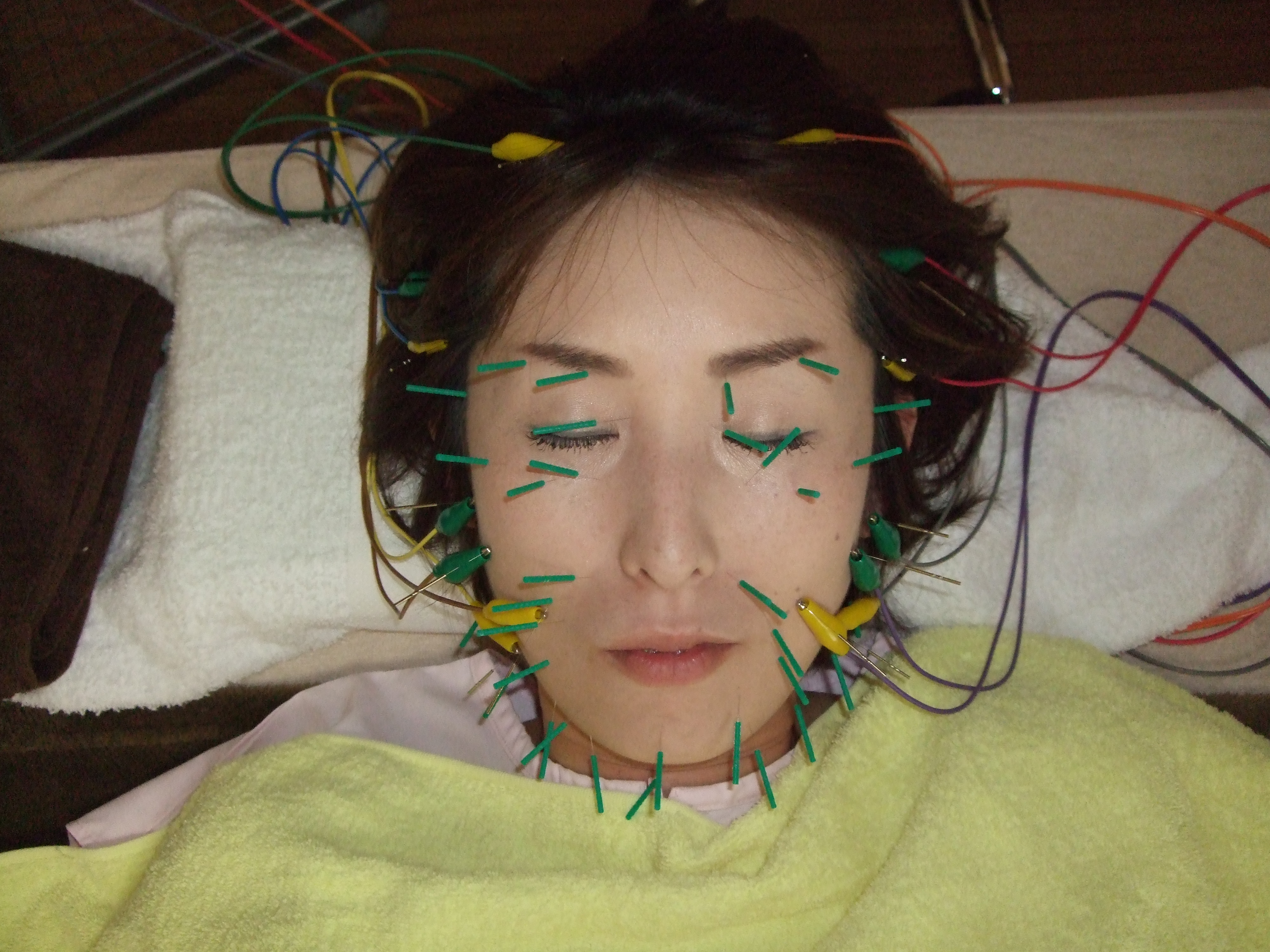 立体造顔美容鍼の画像