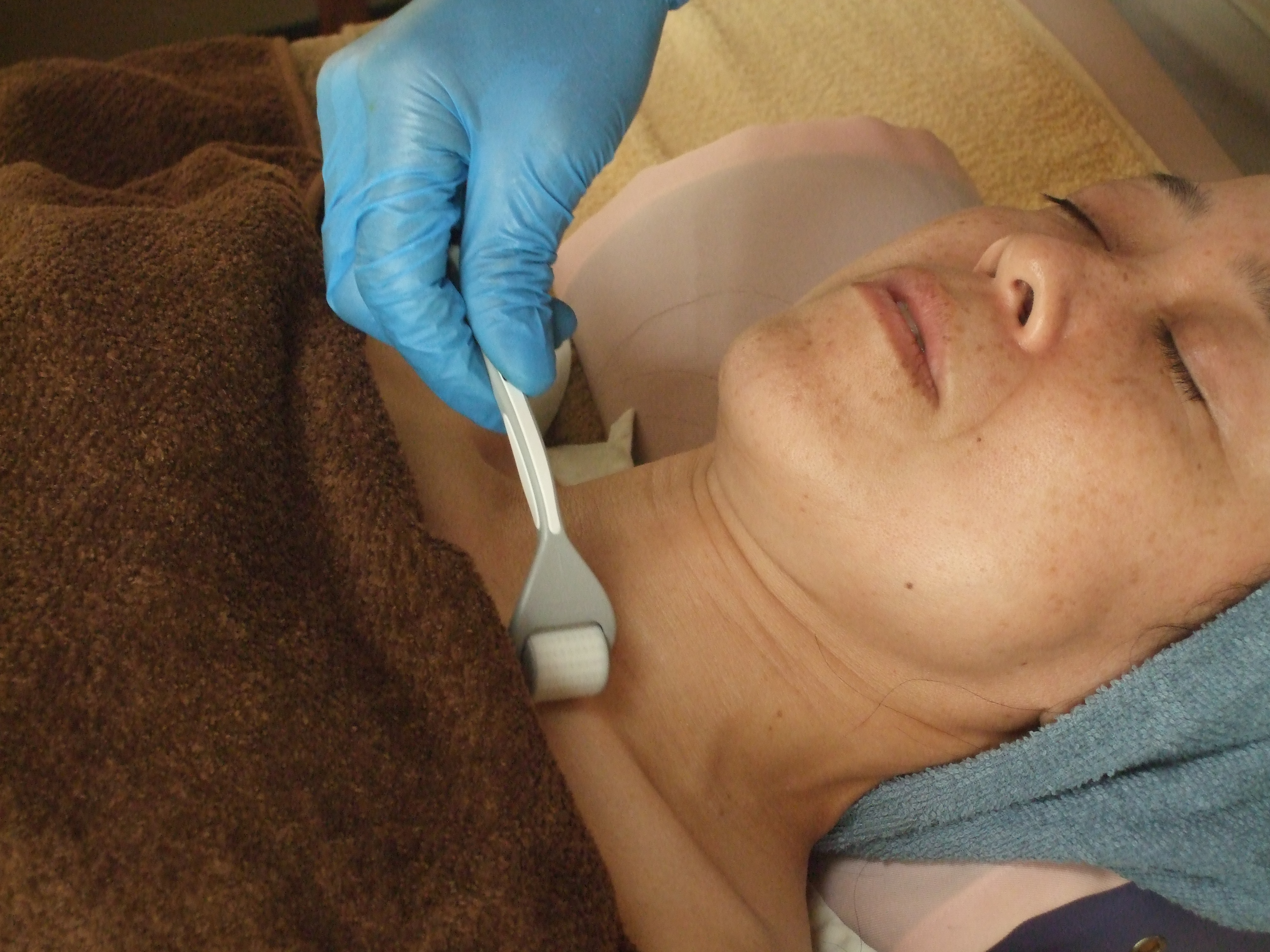 デコルテ　ダーマローラー施術の画像