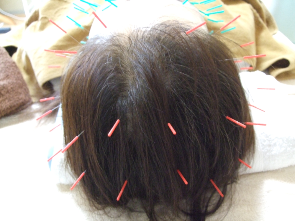頭部刺鍼の画像