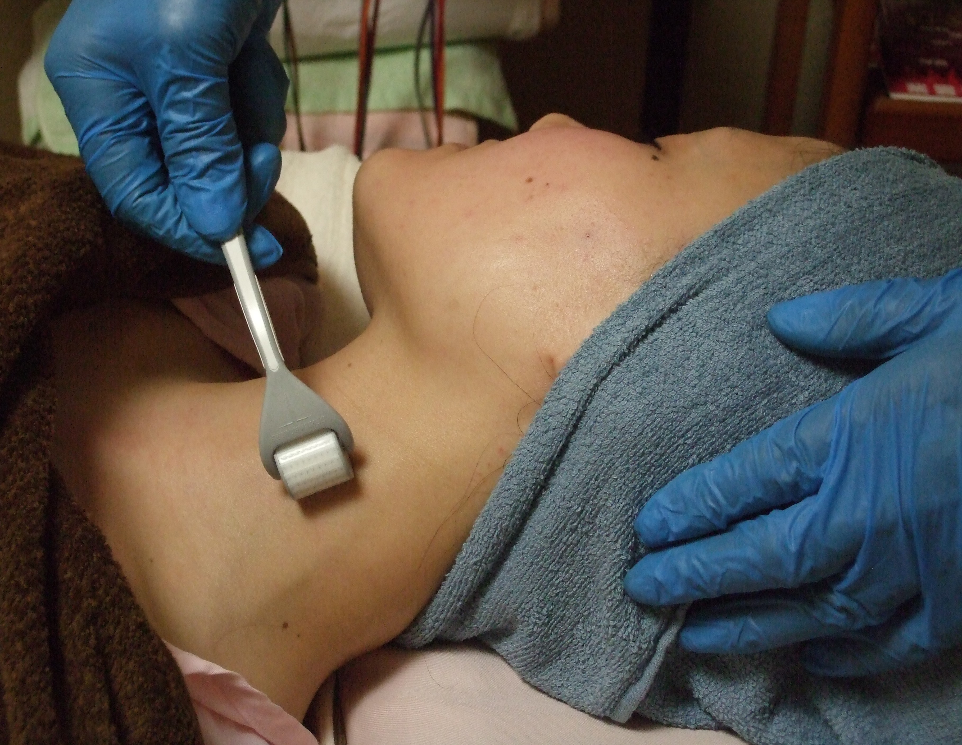 ダーマローラー施術の画像