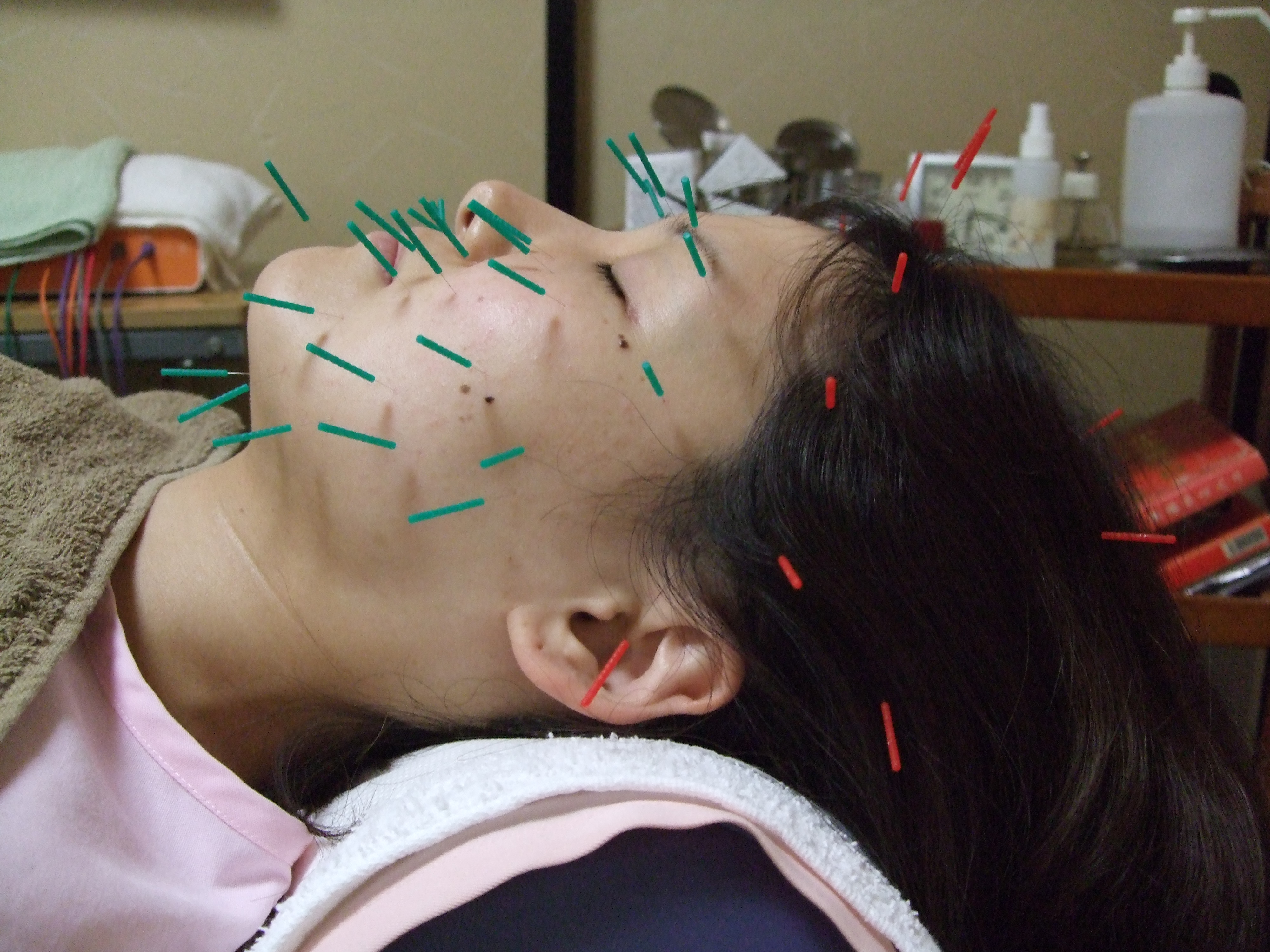 美顔鍼刺鍼の画像