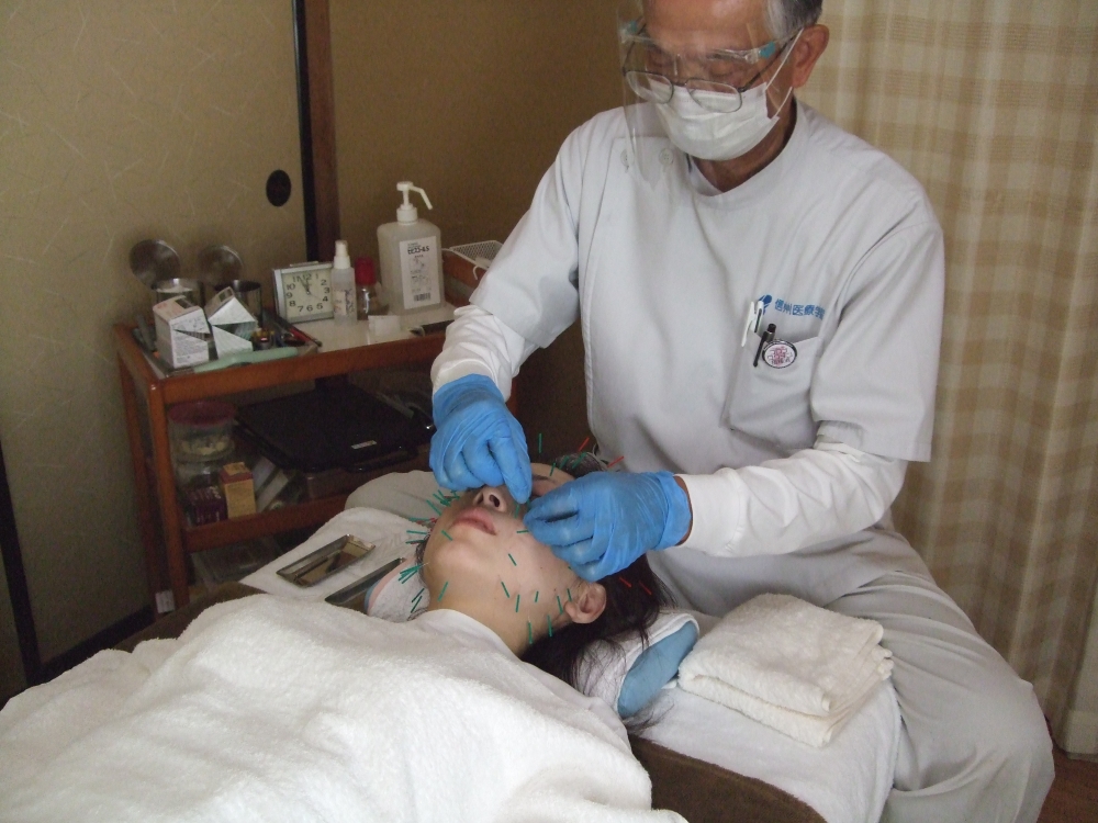 美容鍼施術の画像