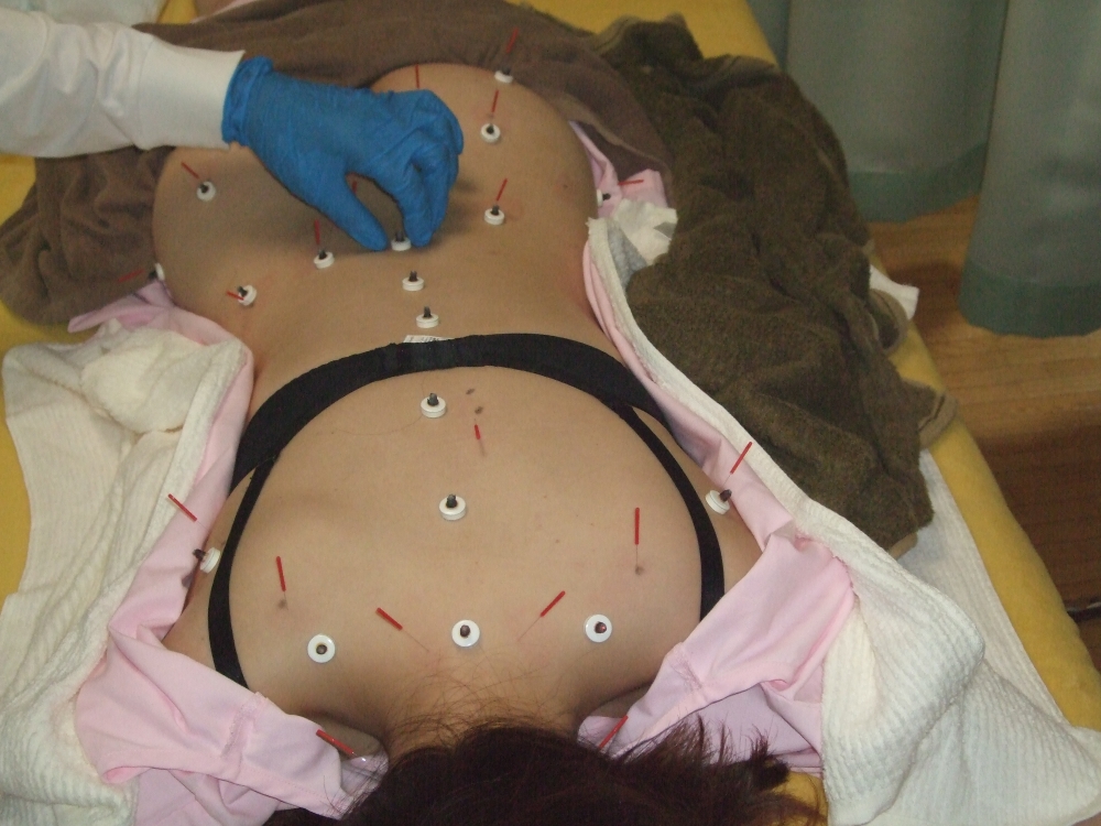腰臀部への刺鍼、台座灸(二種類)の温熱作用の画像