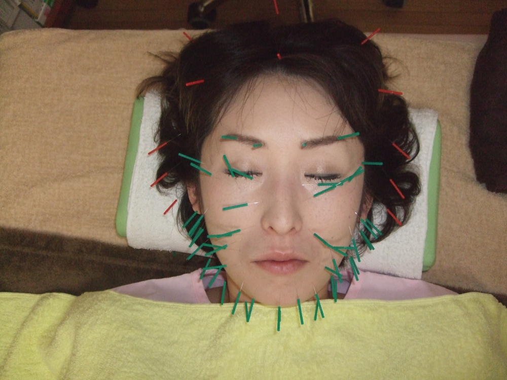 美容鍼施術により身体全体の健康増進になりますの画像