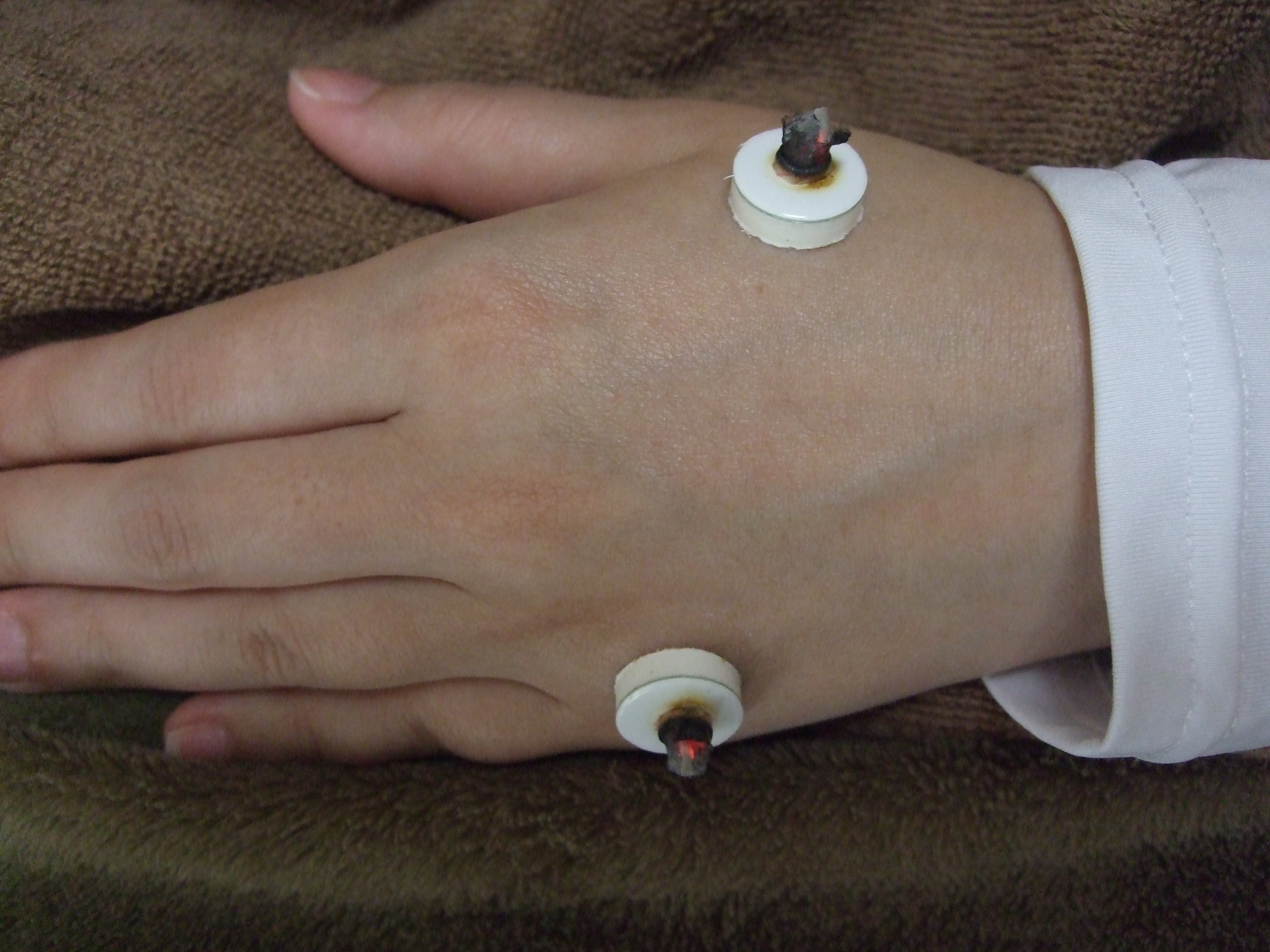 手の施灸の画像