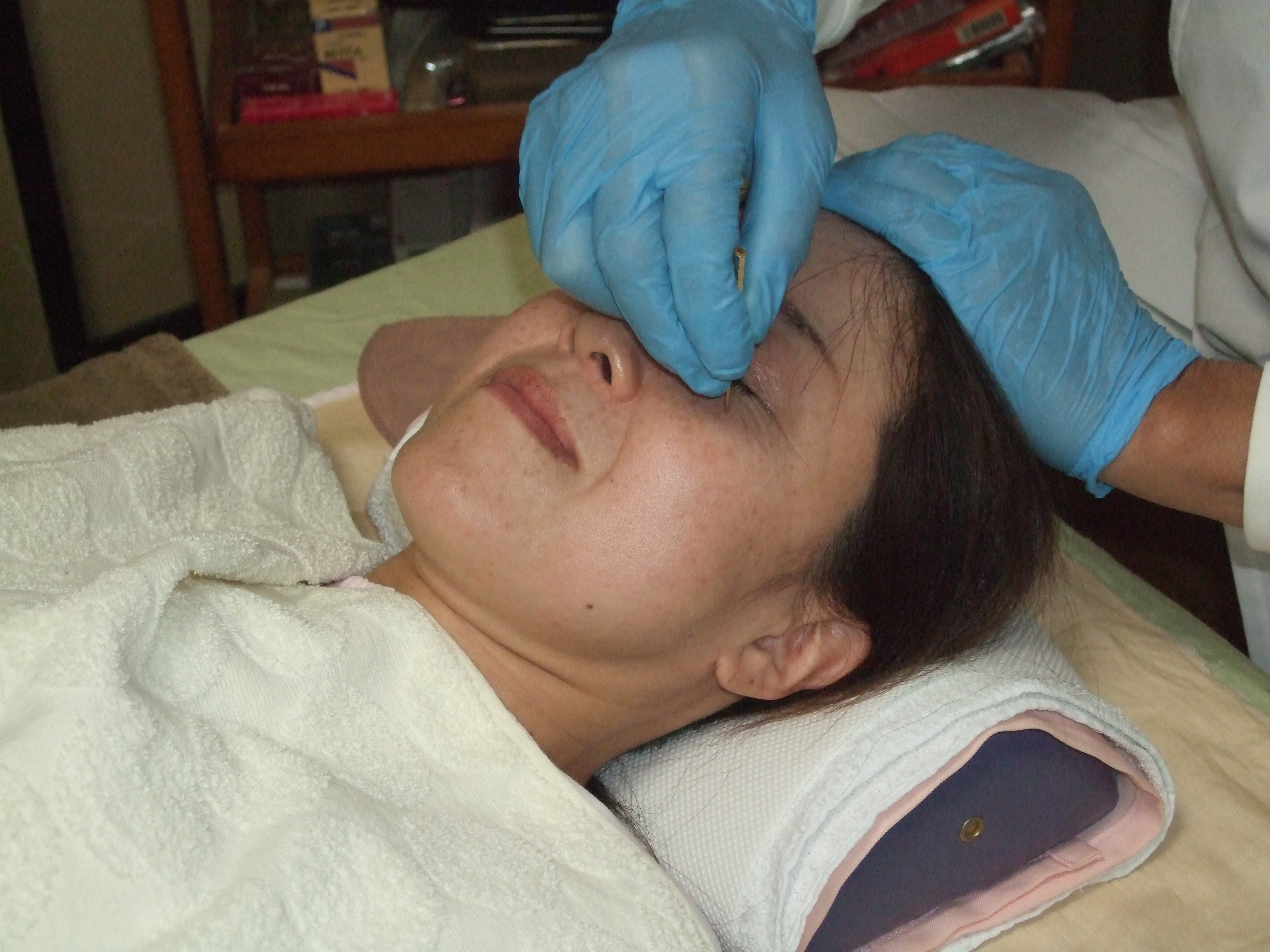 FT美顔鍼の画像