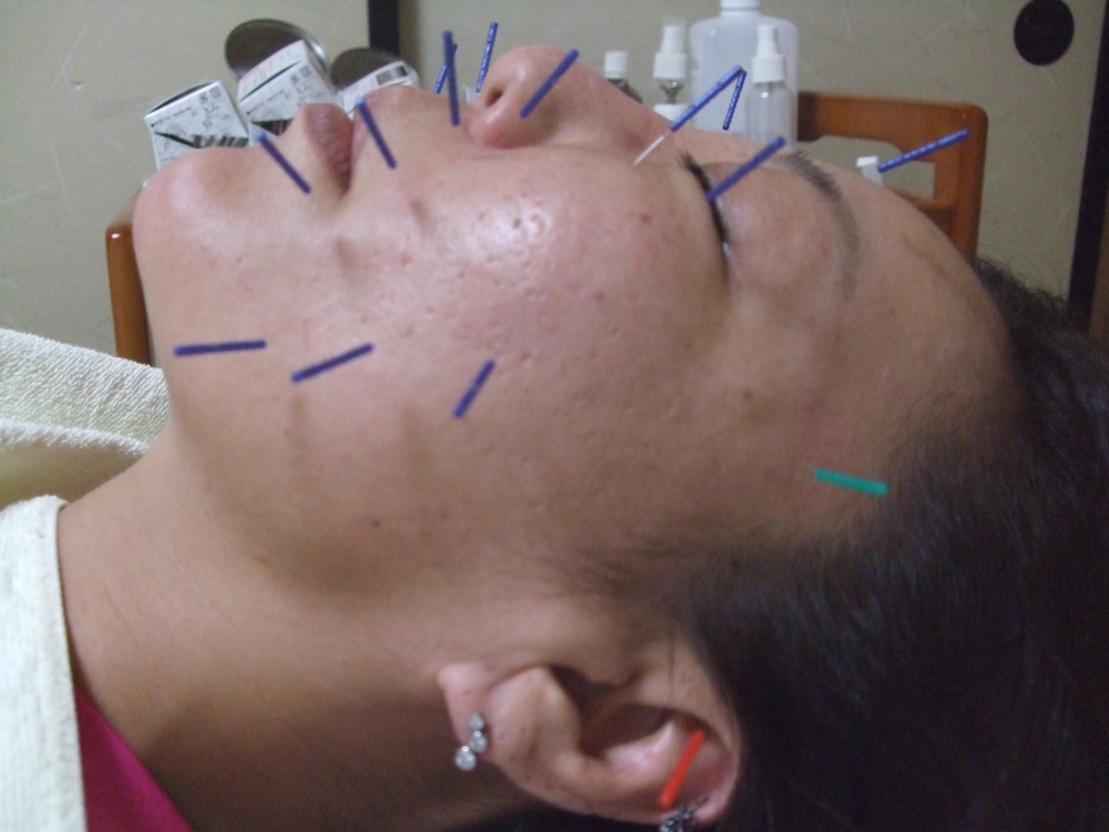 気になるところに美容鍼施術中　はり、潤いなど甦らせます。の画像