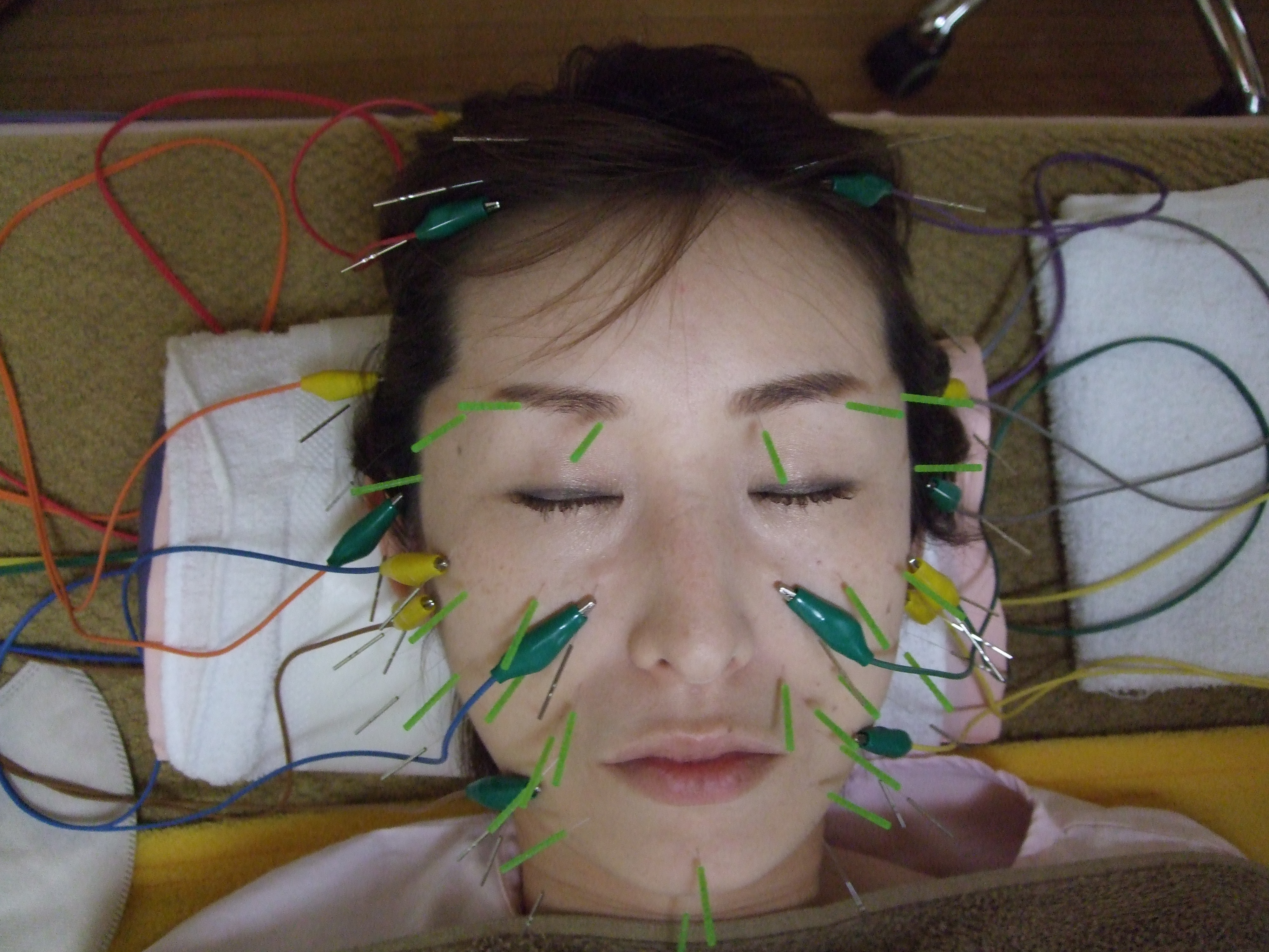 立体造顔美容鍼施術の画像