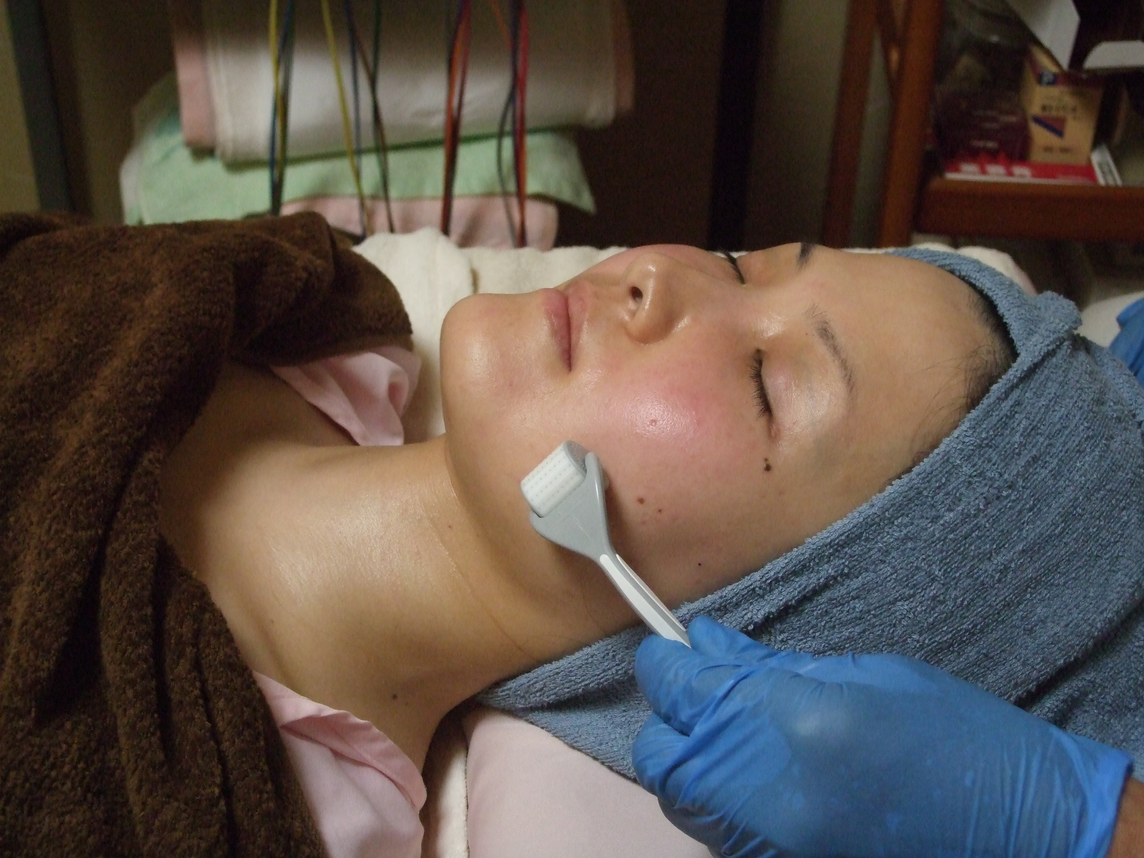 ダーマローラー施術の画像