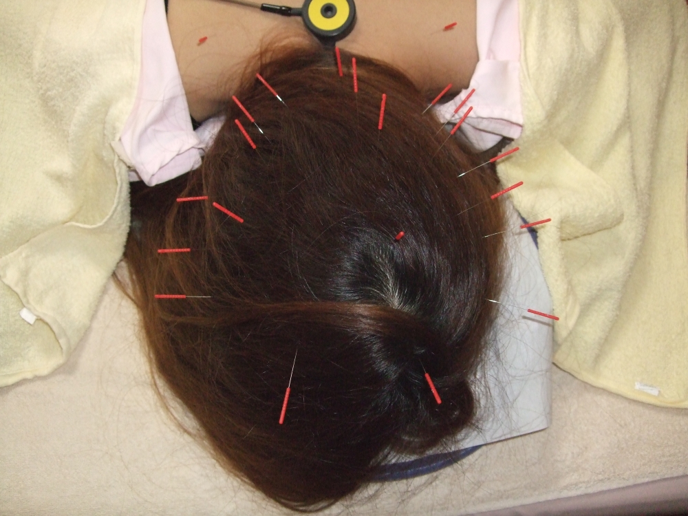 美髪頭皮鍼　施術の画像