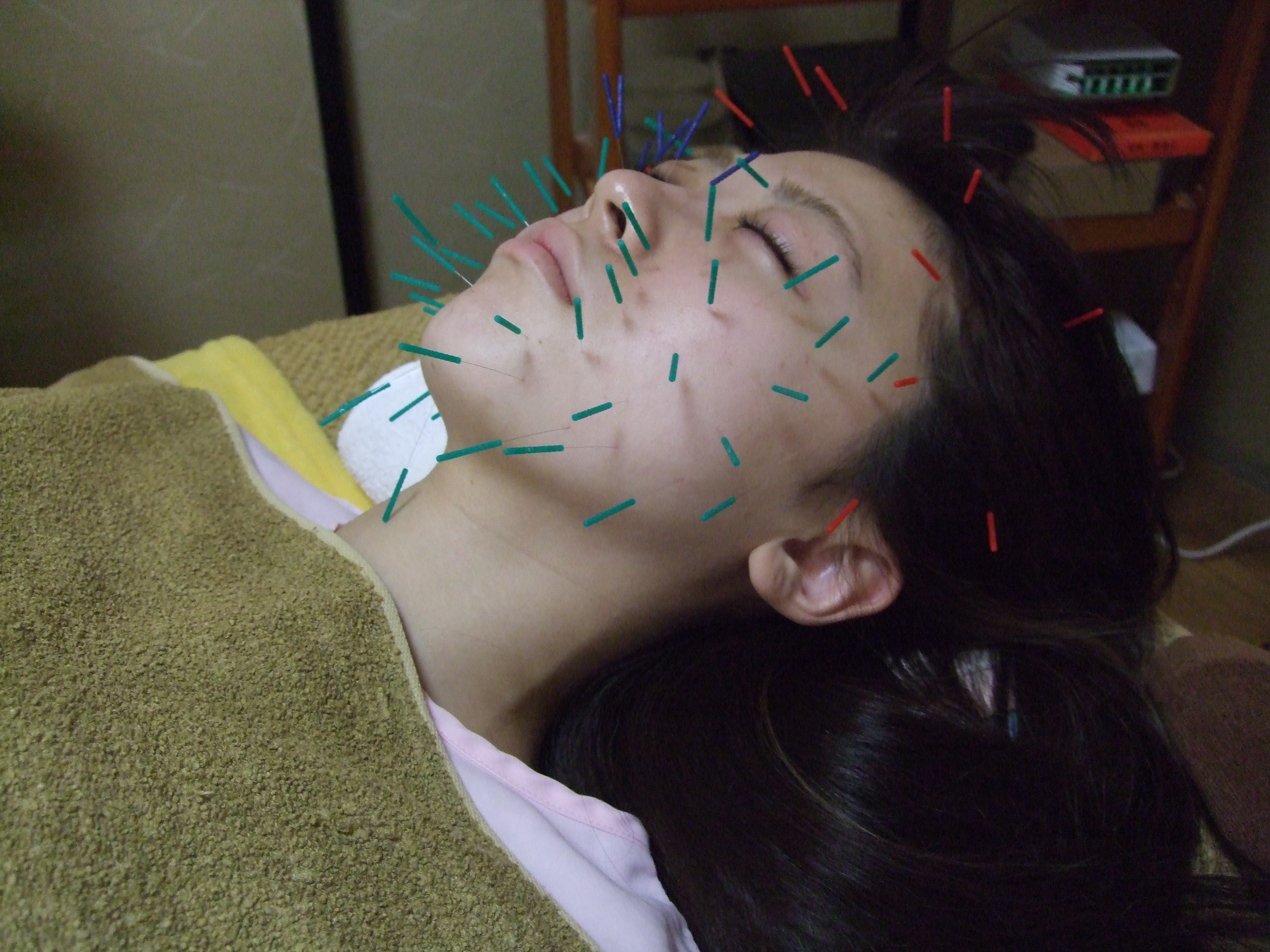 美顔鍼の画像