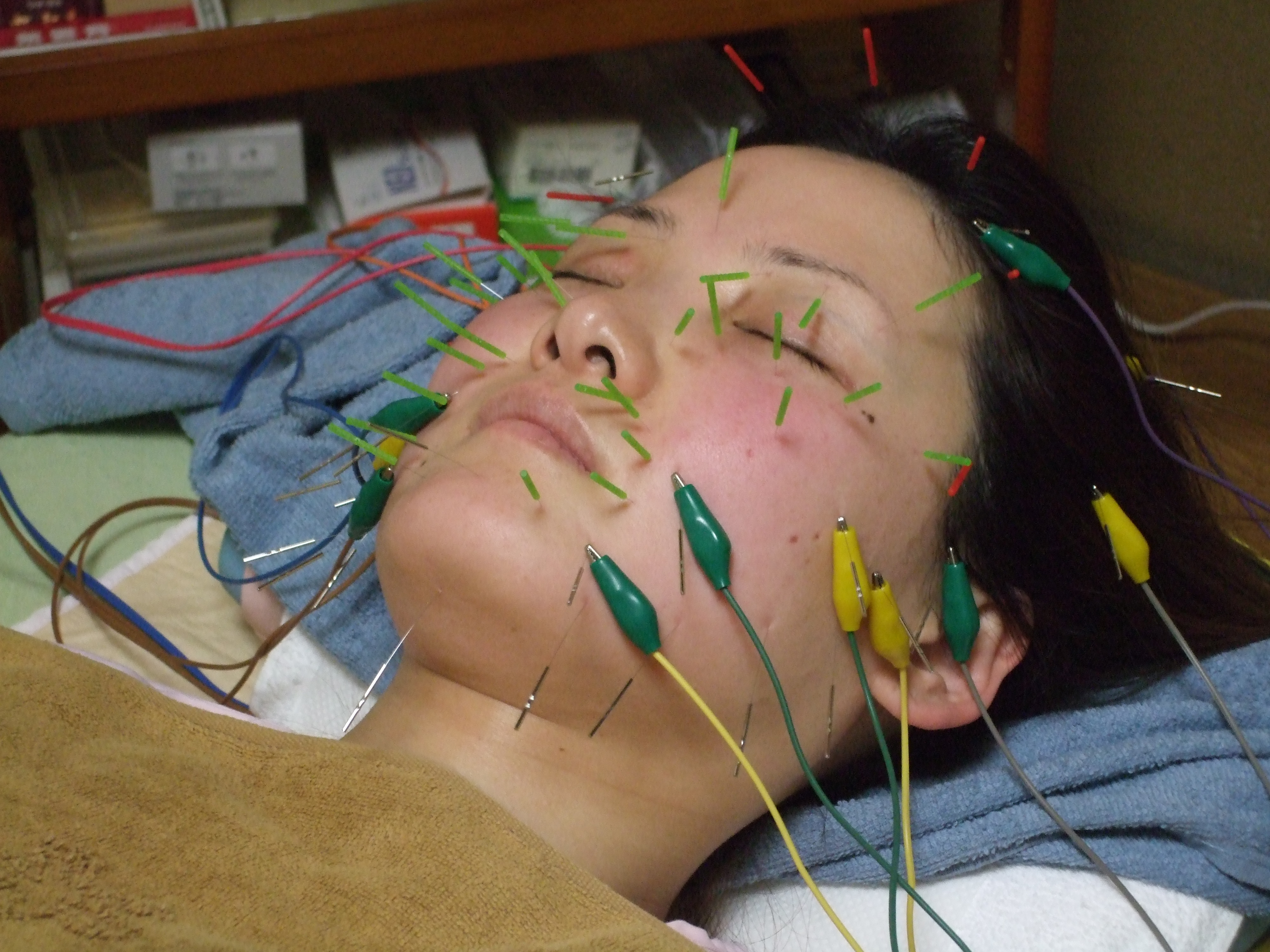 立体造顔美容鍼の画像