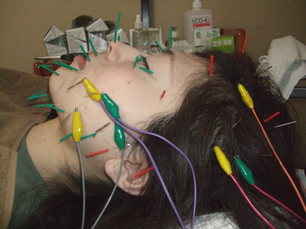 頭皮鍼＆顔面鍼にパルマス通電刺激の画像
