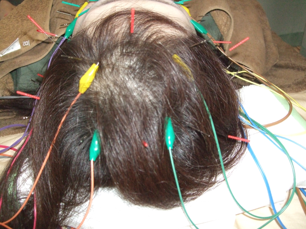 頭皮鍼にパルマス通電刺激の画像
